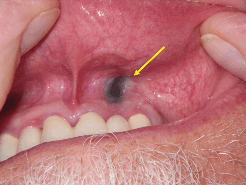 Dental Update - Malignant oral melanoma: how to spot it and how it is  managed